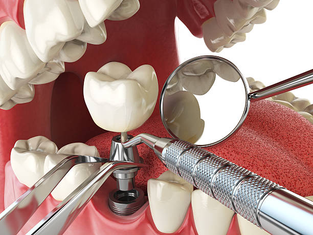 Best Dental Abscess Treatment in North Logan, UT